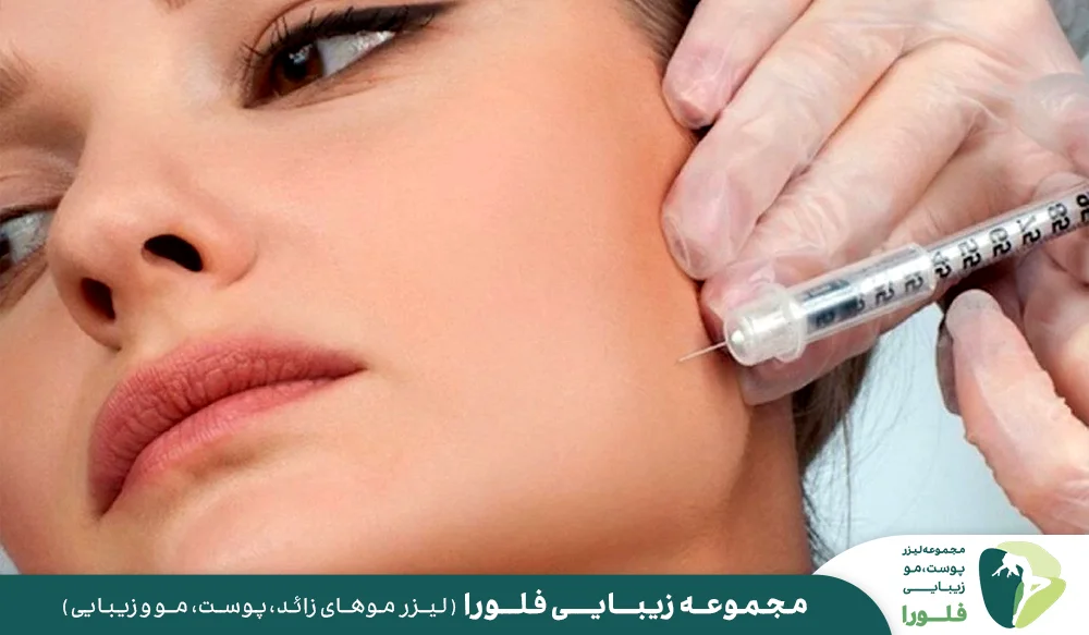زاویه سازی فک از طریق تزریق بوتاکس