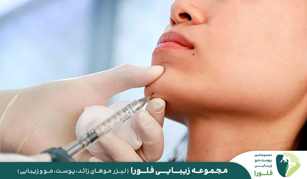 زاویه سازی فک با فیلر (تزریق ژل)