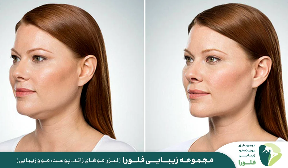 زاویه سازی فک چیست؟