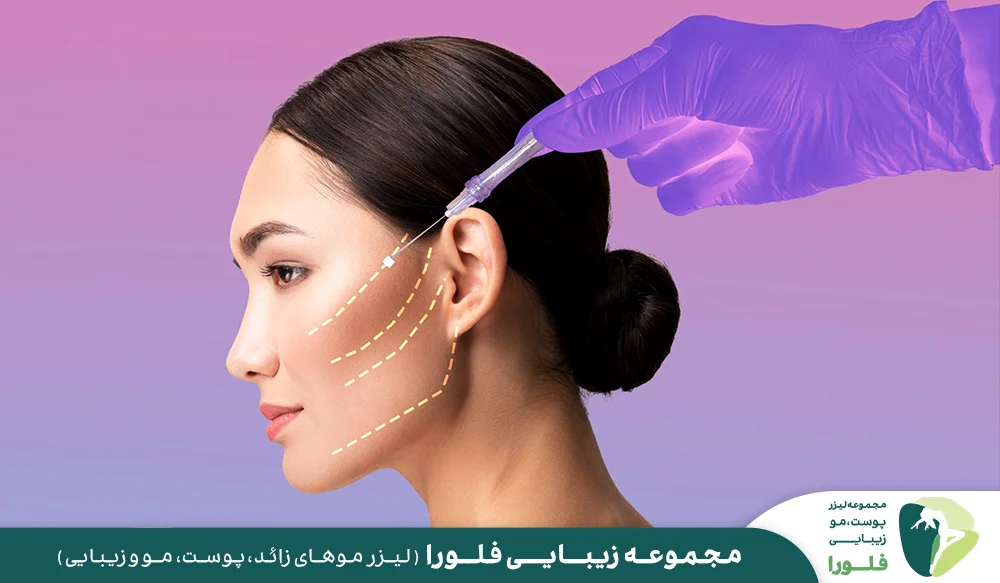 لیفت صورت با نخ چیست؟