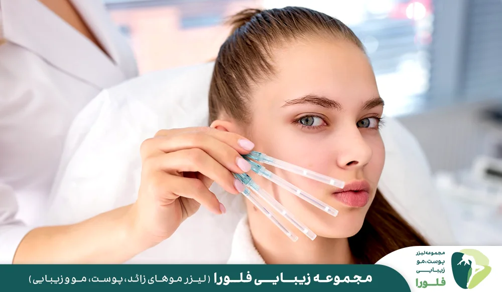 مزایای لیفت صورت با نخ
