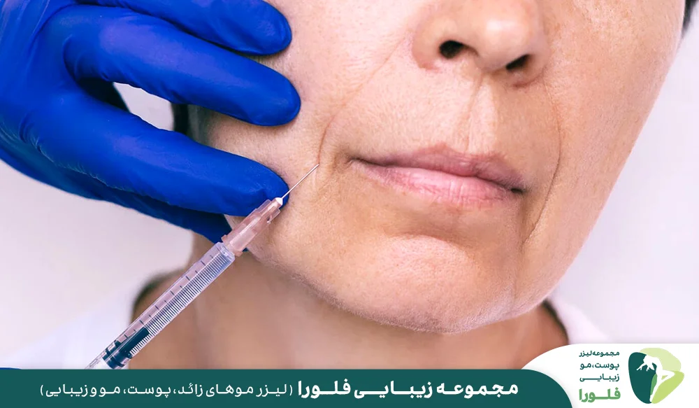 بعد از تزریق فیلر خط خنده چه مراقبت هایی لازم است؟