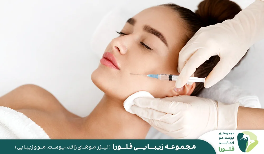 رفع خط خنده (فیلر خط خنده)
