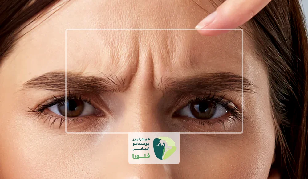 رفع خط اخم