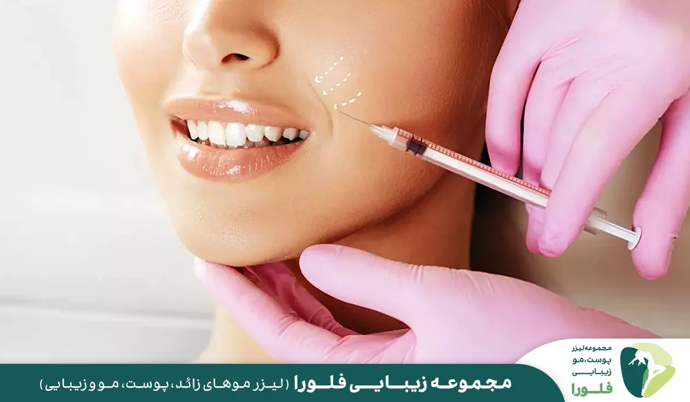 رفع خط خنده با تزریق ژل در پونک