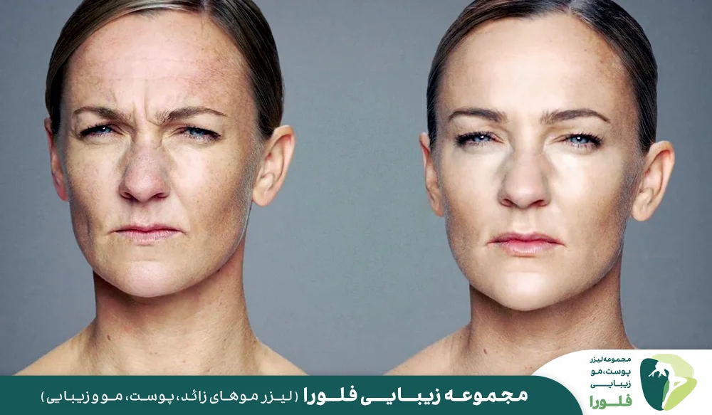 مزایای تزریق ژل و فیلر برای رفع خطوط ابرو