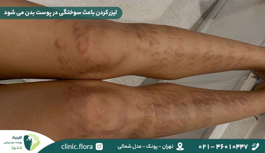 لیزر کردن باعث سوختگی در پوست بدن می شود