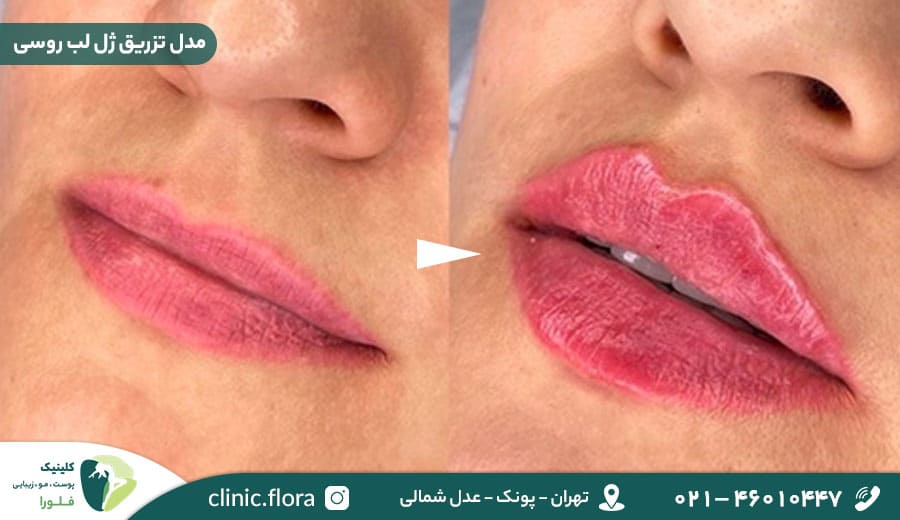 مدل تزریق ژل لب روسی