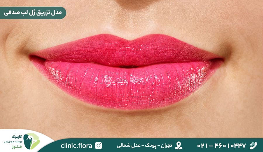 مدل تزریق ژل لب صدفی