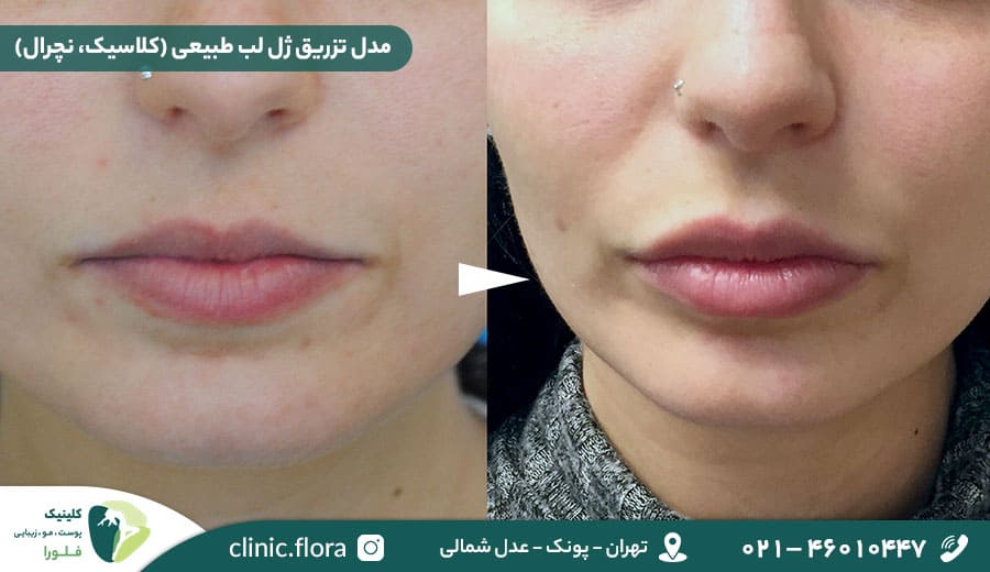 مدل تزریق ژل لب طبیعی (کلاسیک، نچرال)