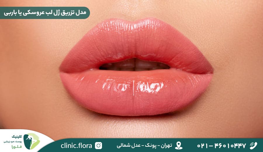 مدل تزریق ژل لب عروسکی یا باربی