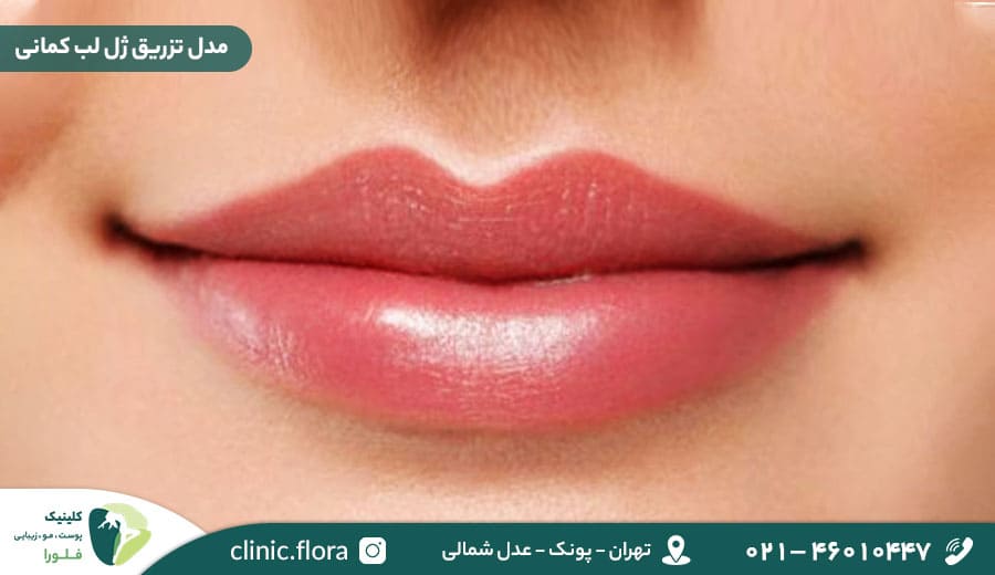 مدل تزریق ژل لب کمانی