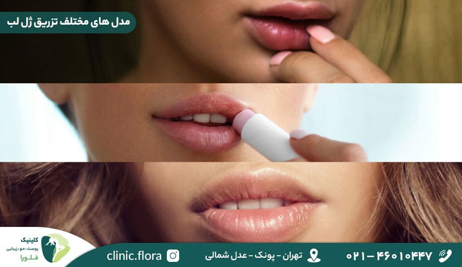 مدل های مختلف تزریق ژل لب