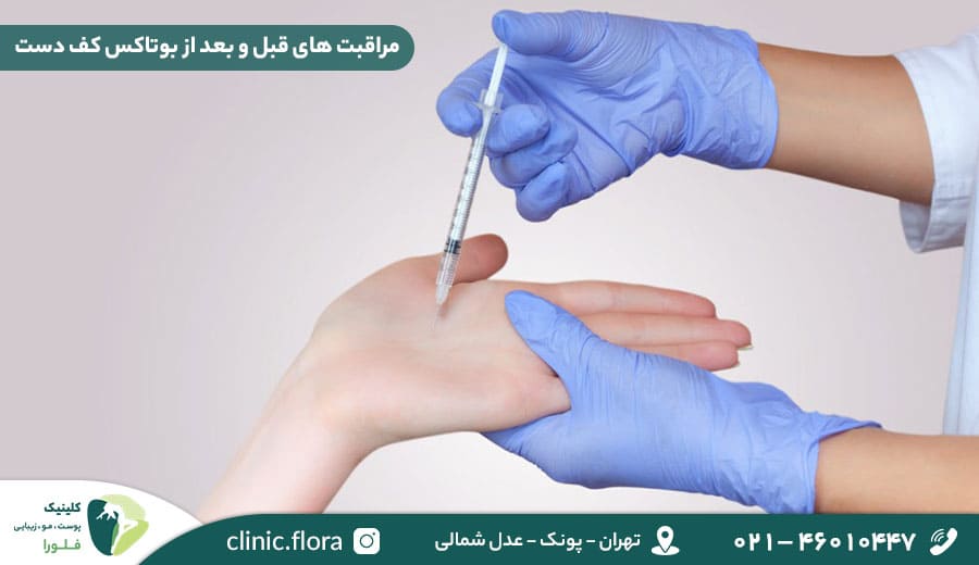 مراقبت های قبل و بعد از بوتاکس کف دست