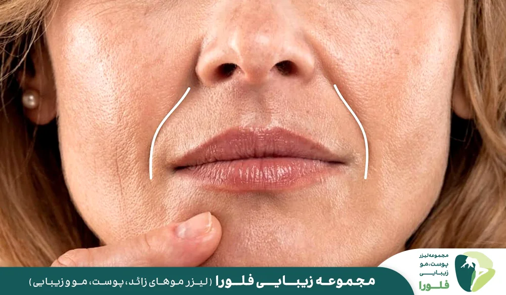 مزایای فیلر خط خنده چیست؟