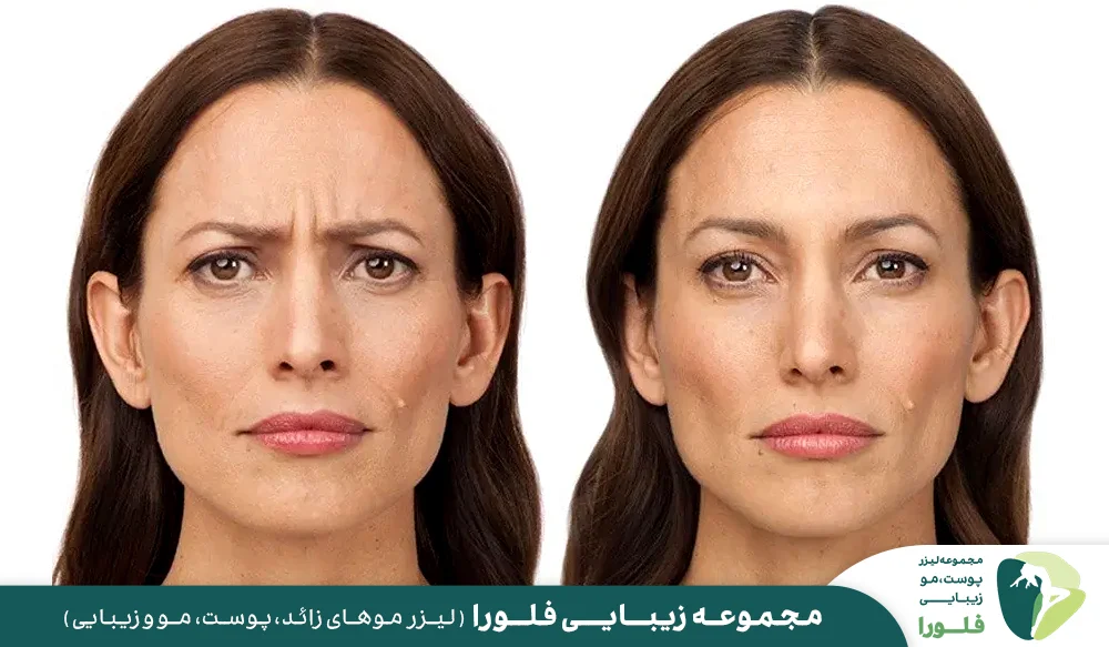 روش های مختلف رفع خط اخم (بین ابرو)