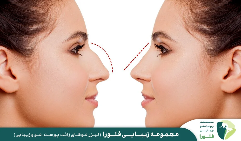 همه چیز درباره اصلاح فرم بینی