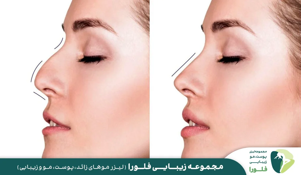 کاربرد تزریق فیلر بینی