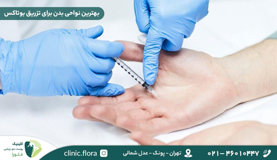 بهترین نواحی بدن برای تزریق بوتاکس