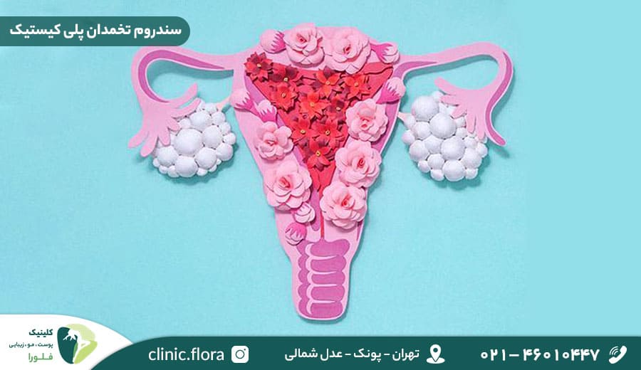 سندروم تخمدان پلی کیستیک