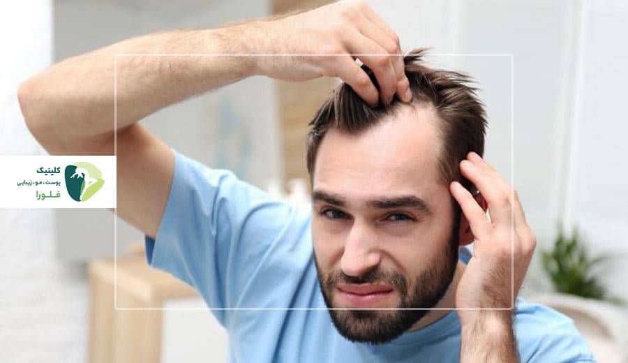 عوامل ریزش مو در آقایان