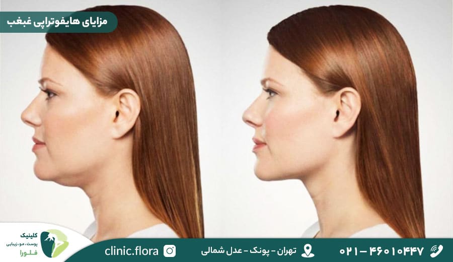 مزایای هایفوتراپی غبغب