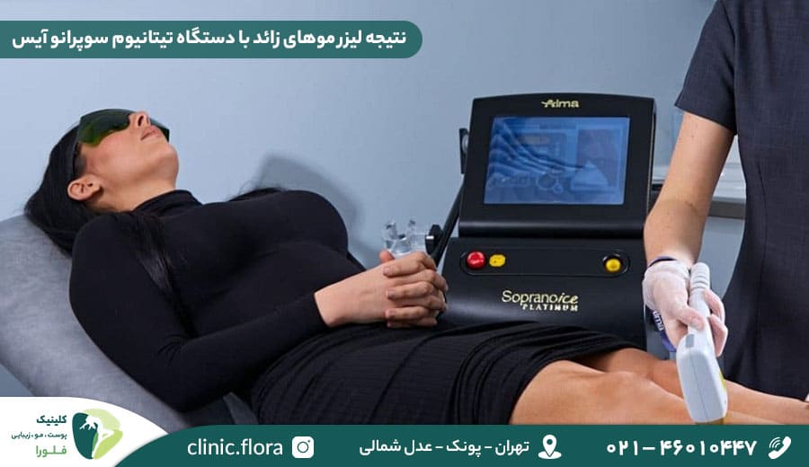 نتیجه لیزر موهای زائد با دستگاه تیتانیوم سوپرانو آیس