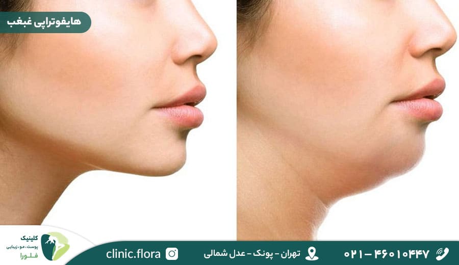 هایفوتراپی غبغب