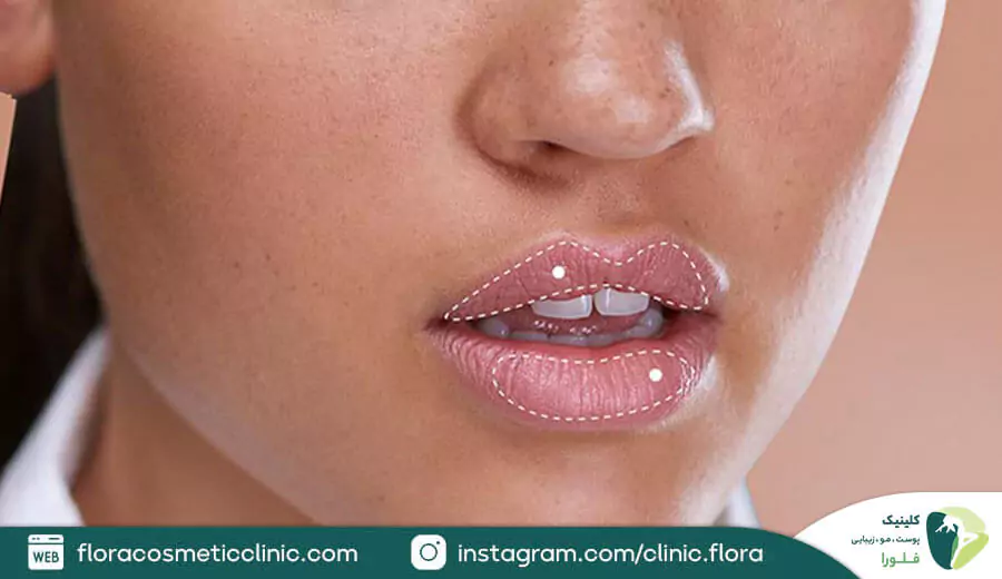 برای تزریق ژل لب عروسکی چند سی سی لازم است؟