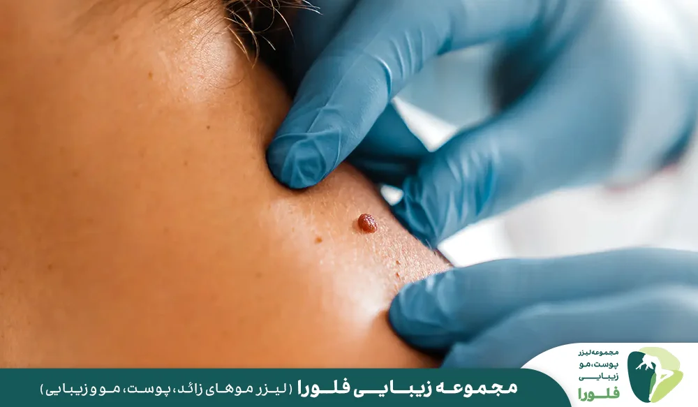 همه چیز درباره برداشتن خال و زگیل