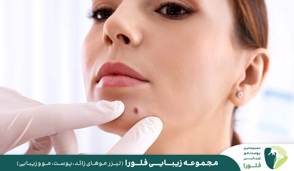 انواع روش برداشتن خال و زگیل