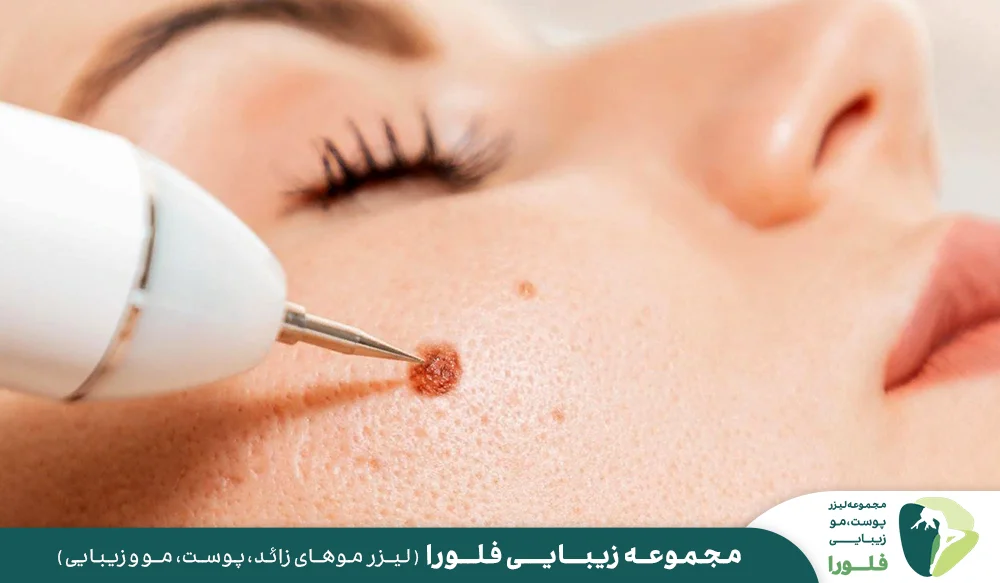 برداشتن خال و زگیل با لیزر