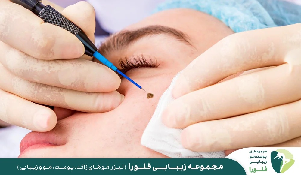 برداشتن خال و زگیل با جراحی