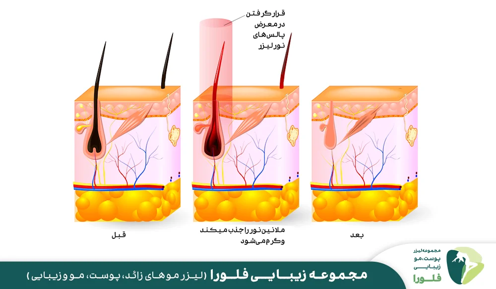 فناوری و مکانیسم عملکرد لیزر موهای زائد