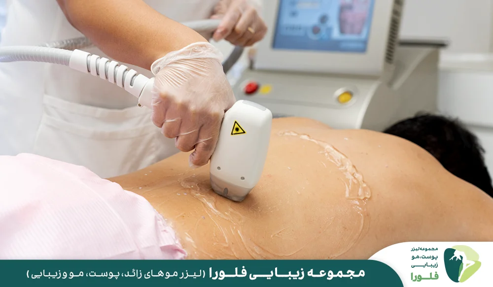 مزایای استفاده از لیزر در حذف موهای زائد