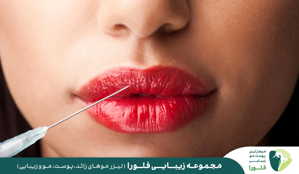هزینه تزریق لب در تهران و کلینیک فلورا