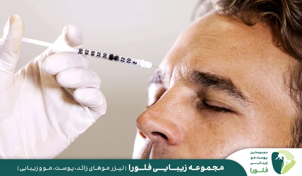 بوتاکس بهترین روش برای درمان تعریق صورت