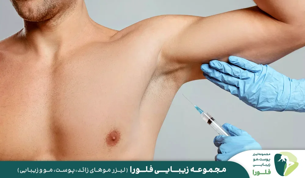 بوتاکس برای جلوگیر از تعریق زیر بغل