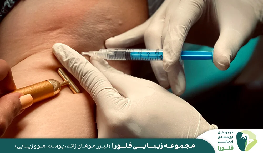 چگونگی رفع تعریق با بوتاکس