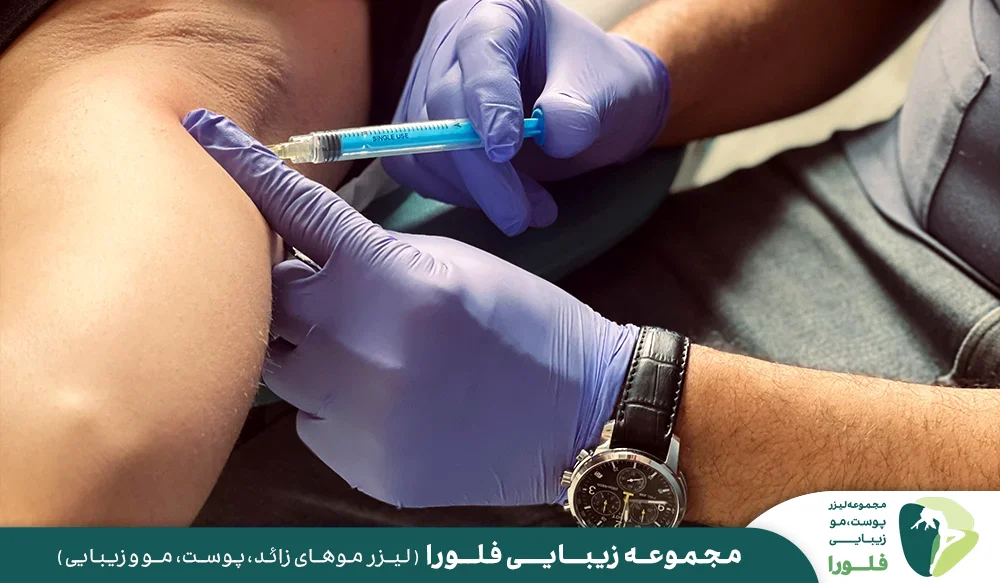 رفع تعریق با بوتاکس چیست؟
